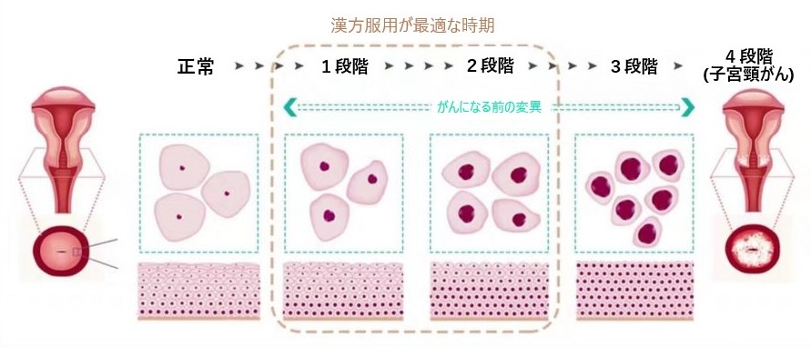 HPVの４段階